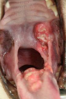 La gingivitis tiene úlceras muy dolorosas